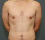 MALE CHEST CONTOURING / GYNECOMASTIA: Case 50 After